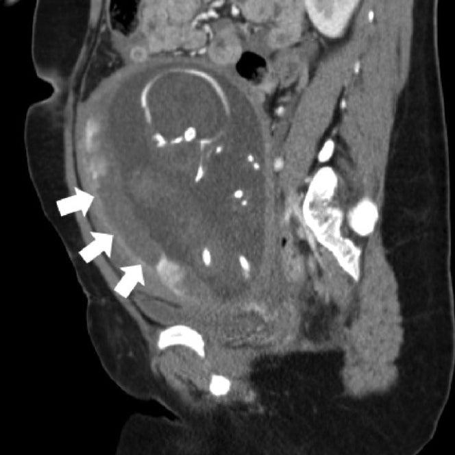 CT scan showing placental damage from seatbelt
